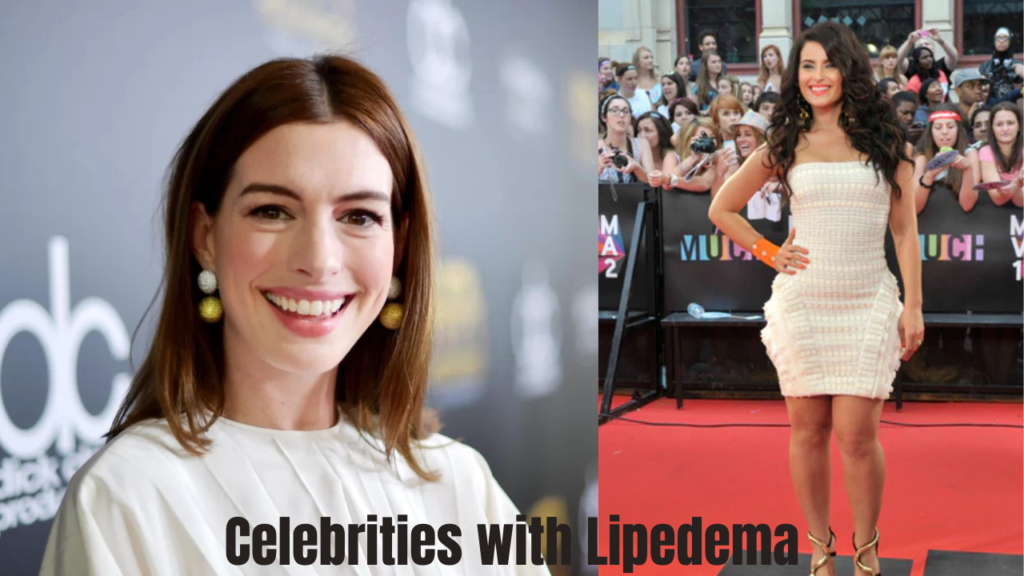 Celebrities with Lipedema