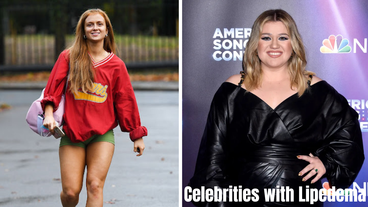 Celebrities with Lipedema